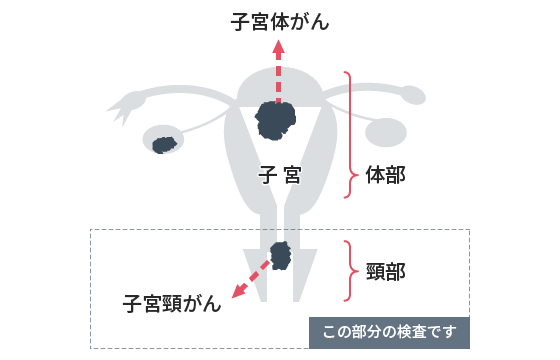 子宮頸がん検査（細胞診）