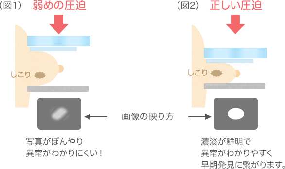 マンモグラフィーの圧迫について