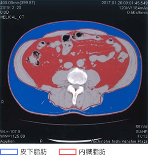 腹部CT画像測定画面